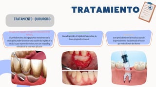 TRATAMIENTO
TRATAMIENTO QUIRURGICO
Cirugíaconcolgajos(cirugíadereduccióndelas
bolsas).
Elperiodoncistahacepequeñasincisionesenla
encíaparapoderlevantarunaseccióndeltejidodela
encía,loqueexponelasraícesparaunraspadoy
alisadodelaraízmáseficaces
Injertos de tejido blando.
Cuando pierdes el tejido de las encías, la
línea gingival retrocede
Injertoóseo.
Esteprocedimientoserealizacuando
laperiodontitishadestruidoelhueso
querodealaraízdeldiente
 