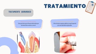 TRATAMIENTO
TRATAMIENTO QUIRURGICO
Regeneracióntisularguiada.
Estopermitequeelhuesodestruidopor
lasbacteriasvuelvaacrecer
Proteínas estimulantes de tejidos.
Otra técnica supone aplicar un gel especial
a la raíz del diente afectado.
 