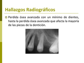 Hallazgos Radiográficos
   Perdida ósea avanzada con un mínimo de dientes,
    hasta la perdida ósea avanzada que afecta la mayoría
    de las piezas de la dentición.
 
