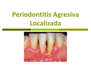 Periodontitis Agresiva
     Localizada
 
