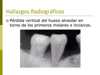 Hallazgos Radiográficos
   Pérdida vertical del hueso alveolar en
    torno de los primeros molares e incisivos.
 