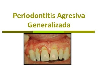 Periodontitis Agresiva
    Generalizada
 