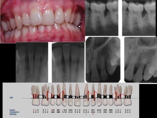 Aggressive Periodontitis