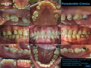 Aggressive Periodontitis