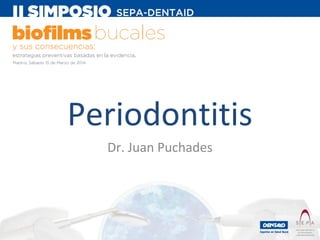 Periodontitis
Dr. Juan Puchades

 