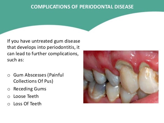 Foods To Eat When You Have Gingivitis Foods To Eat When You Have Gingivitis