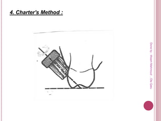 4. Charter's Method :
Doneby:WeamMahmoud,OlaQatu
 