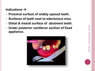 Indications 
 Proximal surface of widely spaced teeth.
 Surfaces of teeth next to edentulous area.
 Distal & mesial surface of abutment teeth.
 Under posterior cantilever section of fixed
appliance.
Doneby:WeamMahmoud,OlaQatu
 