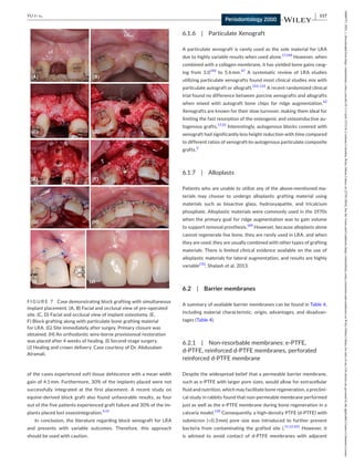 Periodontology 2000 - 2023 - Yu - Simultaneous or staged lateral ridge ...