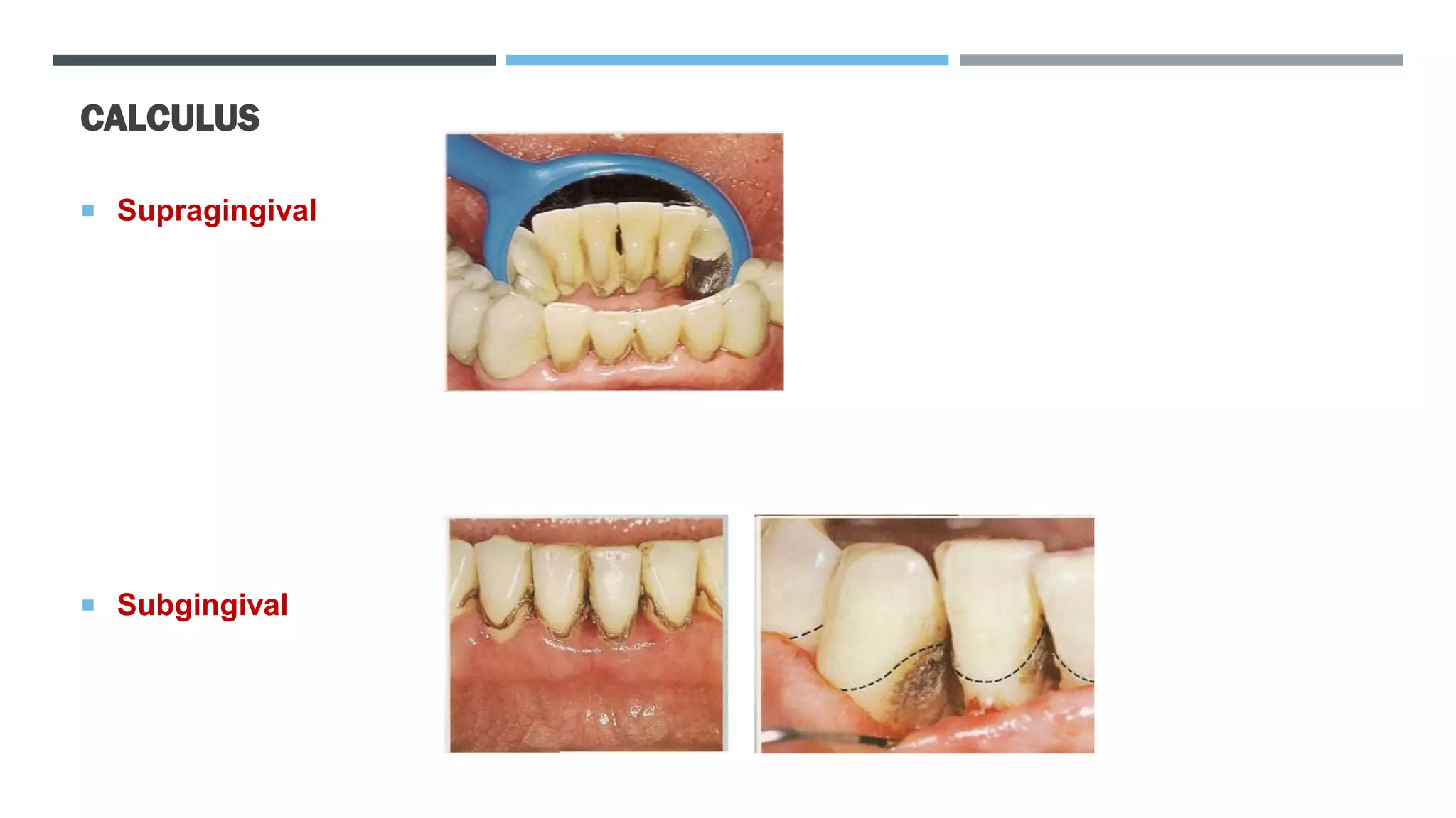 CALCULUS
 Supragingival
 Subgingival
 
