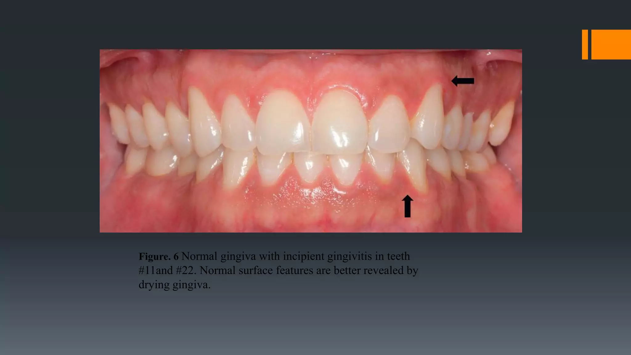Periodontology lecture 1 part 1 2003 | PPT