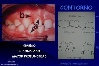 CONTORNO




                            GRUESO
                          REDONDEADO
              MAYOR PROFUNDIDAD
         09/23/11
DRA. SANDRA HINCAPIE N.                MATHEWSON/PRIMOSCH 1995
 