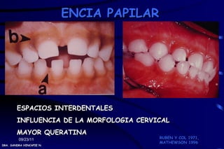 ENCIA PAPILAR




        ESPACIOS INTERDENTALES
        INFLUENCIA DE LA MORFOLOGIA CERVICAL
        MAYOR QUERATINA
         09/23/11                        RUBEN Y COL 1971,
                                         MATHEWSON 1996
DRA. SANDRA HINCAPIE N.
 