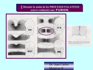 § Durante la unión de los PROCESOS PALATINOS
§ Durante la unión de los PROCESOS PALATINOS
       ocurre realmente una FUSION.
        ocurre realmente una FUSION.




                     Dr. Juan Carlos
                     Munévar N
 
