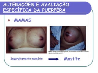 ALTERAÇÕES E AVALIAÇÃO 
ESPECÍFICA DA PUERPÉRA 
 MAMAS 
Ingurgitamento mamário Mastite 
 