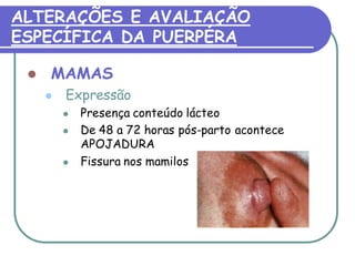 ALTERAÇÕES E AVALIAÇÃO 
ESPECÍFICA DA PUERPÉRA 
 MAMAS 
 Expressão 
 Presença conteúdo lácteo 
 De 48 a 72 horas pós-parto acontece 
APOJADURA 
 Fissura nos mamilos 
 