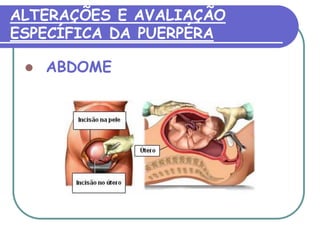 ALTERAÇÕES E AVALIAÇÃO 
ESPECÍFICA DA PUERPÉRA 
 ABDOME 
 