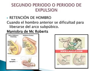 RETENCIÓN DE HOMBRO
Cuando el hombro anterior se dificultad para
 liberarse del arco subpúbico.
Maniobra de Mc Roberts
 