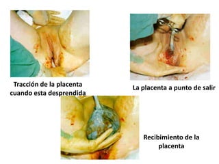 Tracción de la placenta   La placenta a punto de salir
cuando esta desprendida




                              Recibimiento de la
                                   placenta
 