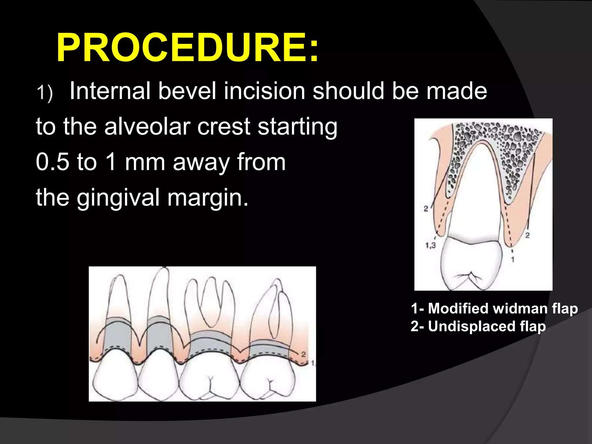 periodontal flap techniques | PPTX