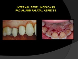 INTERNAL BEVEL INCISION IN
FACIAL AND PALATAL ASPECTS
 