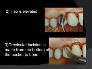 2) Flap is elevated
3)Crevicular incision is
made from the bottom of
the pocket to bone
 