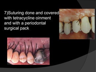 7)Suturing done and covered
with tetracycline oinment
and with a periodontal
surgical pack
 