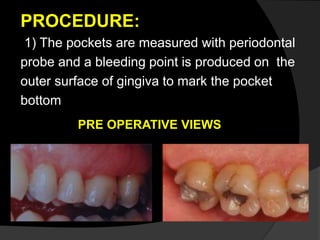 PROCEDURE:
1) The pockets are measured with periodontal
probe and a bleeding point is produced on the
outer surface of gingiva to mark the pocket
bottom
PRE OPERATIVE VIEWS
 