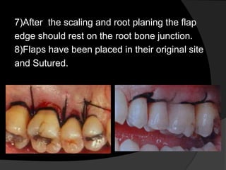 7)After the scaling and root planing the flap
edge should rest on the root bone junction.
8)Flaps have been placed in their original site
and Sutured.
 