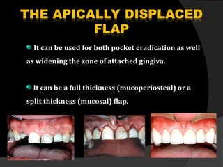 It can be used for both pocket eradication as well
as widening the zone of attached gingiva.
It can be a full thickness (mucoperiosteal) or a
split thickness (mucosal) flap.
 