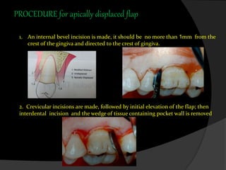 PROCEDURE for apically displaced flap
1. An internal bevel incision is made, it should be no more than 1mm from the
crest of the gingiva and directed to the crest of gingiva.
2. Crevicular incisions are made, followed by initial elevation of the flap; then
interdental incision and the wedge of tissue containing pocket wall is removed
 