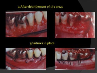 4.After debridement of the areas
5.Sutures in place
 