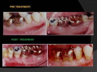 PRE TREATMENT-
POST TREATMENT
 