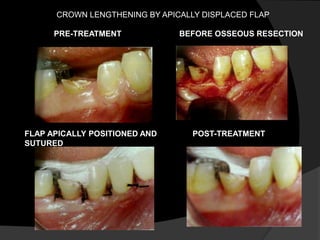 PRE-TREATMENT BEFORE OSSEOUS RESECTION
FLAP APICALLY POSITIONED AND
SUTURED
POST-TREATMENT
CROWN LENGTHENING BY APICALLY DISPLACED FLAP
 