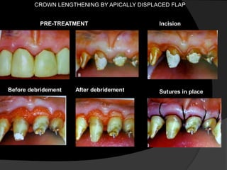 CROWN LENGTHENING BY APICALLY DISPLACED FLAP
PRE-TREATMENT
Before debridement After debridement
Incision
Sutures in place
 