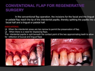 CONVENTIONAL FLAP FOR REGENERATIVE
SURGERY
In the conventional flap operation, the incisions for the facial and the lingual
or palatal flap reach the tip of the interdental papilla, thereby splitting the papilla into a
facial half and a lingual or palatal half.
INDICATIONS:
 When the interdental areas are too narrow to permit the preservation of flap.
 When there is a need for displacing flaps.
The interdental papilla is split beneath the contact point of the two approximating teeth to allow
for reflection of buccal and lingual flaps
 