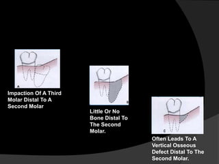 Impaction Of A Third
Molar Distal To A
Second Molar
Little Or No
Bone Distal To
The Second
Molar.
Often Leads To A
Vertical Osseous
Defect Distal To The
Second Molar.
 