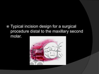  Typical incision design for a surgical
procedure distal to the maxillary second
molar.
 