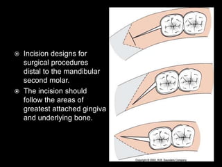  Incision designs for
surgical procedures
distal to the mandibular
second molar.
 The incision should
follow the areas of
greatest attached gingiva
and underlying bone.
 