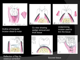 Outline of triangular
incision distal to molar
Cs view showing
wedge removal and
thick tissue
Undermining
incision used to
thin the tissue
Reflection of flap for
osseous correction
Surured tissue
 