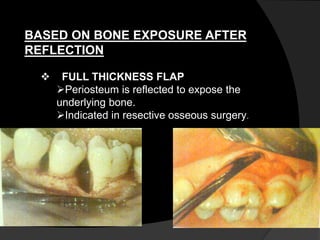BASED ON BONE EXPOSURE AFTER
REFLECTION
 FULL THICKNESS FLAP
Periosteum is reflected to expose the
underlying bone.
Indicated in resective osseous surgery.
 