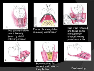 Two parallel incision
over tuberosity
joined by distal
releasing incision
Proper blade angulation
in making intial incision
C&d )Flap reflected
and tissue being
removed from
tuberosity using
periodontal knife
Bone exposed for
correction of osseous
irregularities Final suturing
 