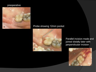preoperative
Probe showing 12mm pocket
Parallel incision made and
joined distally later with
perpendicular incision
 