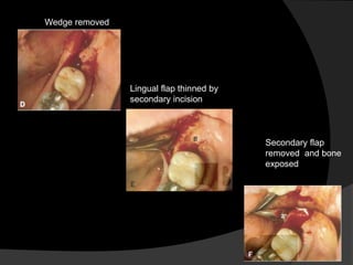 Wedge removed
Lingual flap thinned by
secondary incision
Secondary flap
removed and bone
exposed
 
