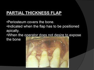 PARTIAL THICKNESS FLAP
•Periosteum covers the bone.
•Indicated when the flap has to be positioned
apically.
•When the operator does not desire to expose
the bone
 