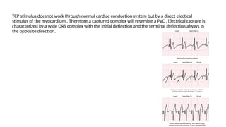 TCP stimulus doesnot work through normal cardiac conduction system but by a direct electical
stimulus of the myocardium . Therefore a captured complex will resemble a PVC . Electrical capture is
characterized by a wide QRS complex with the initial deflection and the terminal deflection always in
the opposite direction.
 
