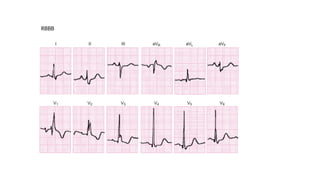 RBBB
 