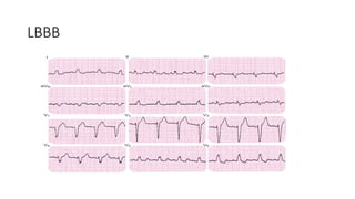 LBBB
 