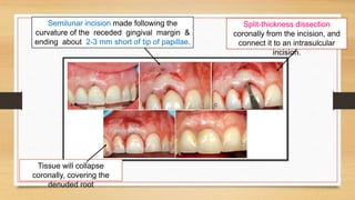 Periodontal plastic surgery | PPTX