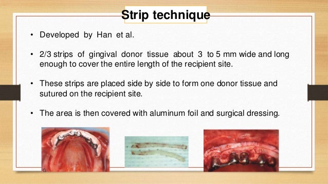 periodontal plastic surgery